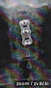 SLY X-RAY